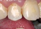 que son las caries | Recurso educativo 688311