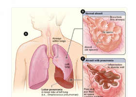 ¿Qué es la neumonía? | Recurso educativo 788329